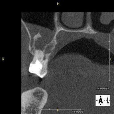 歯性上顎洞炎断面CT2015.09.05　2.jpg
